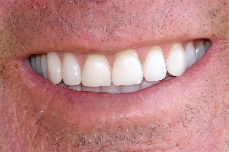 Acrylic Dentures Foosland IL 61845